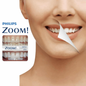 Philips Zoom Teeth Whitening Gels Guide Before & After