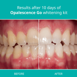 Opalescence Go 10% Teeth Whitening Trays Before & After